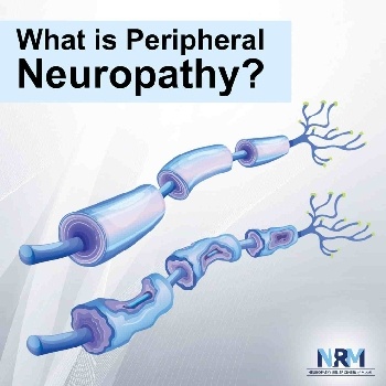 Peripherial Neuropathy - What is peripherial neuropathy