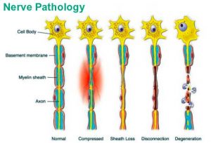 Sensory Neuropathy - Nerves Pathology