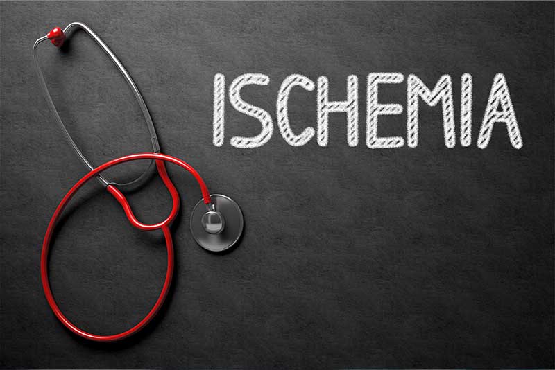 ¿Qué es la isquemia? ¿Por qué es una causa importante de neuropatía periférica? - Neuropatía periférica