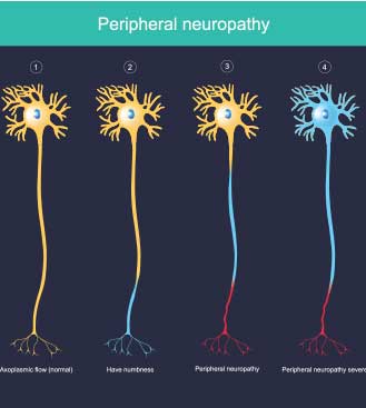 Vibration Therapy for Peripheral Neuropathy - Dr. Alfonso‘s Neuropathy Treatment Protocol