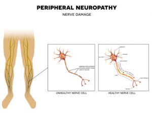 Sensory Neuropathy? - What is sensory neuropathy?