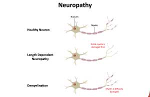 What Are The 4 Major Types of Peripheral Neuropathy?-What Are The 4 Major Types of Peripheral Neuropathy?