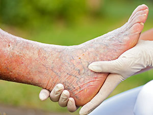 The Primary Cause of Diabetic Peripheral Neuropathy - What are the Different Types of Diabetic Neuropathy