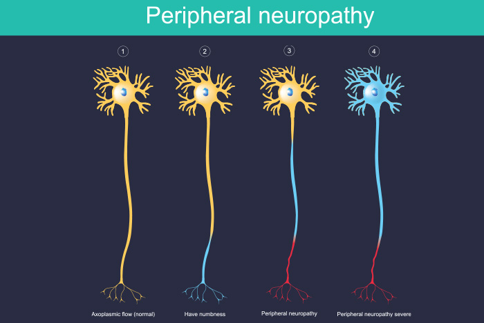 Evaluating the safety, feasibility, and efficacy of non-invasive neuromodulation techniques in chemotherapy-induced peripheral neuropathy: A systematic review.The use of non-invasive neuromodulation techniques for managing CIPN is still in its infancy