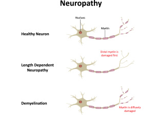 Neuropathy Relief Center of Miami Research Review: Evaluating the safety, feasibility, and efficacy of non-invasive neuromodulation techniques in chemotherapy-induced peripheral neuropathy: A systematic review.Non-invasive central neuromodulation techniques have significant potential for relieving chronic pain and neuropathic symptoms related to CIPN, meriting further exploration.