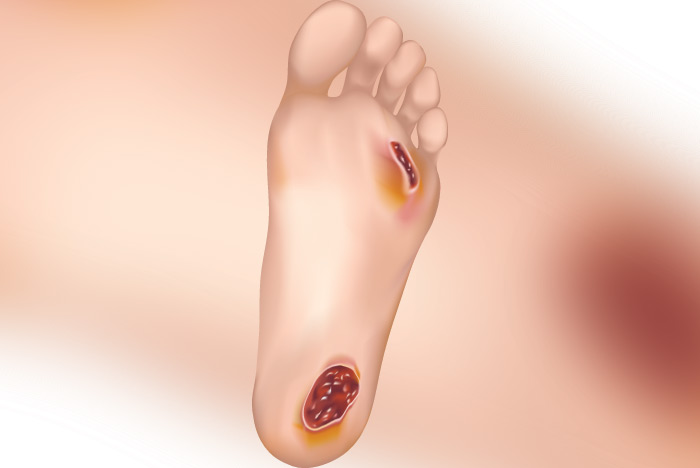 Neuropathy Relief Center of Miami Research Review: Photodynamic Therapy With RLP068 and 630-nm Red LED Light in Foot Ulcers in Patients With Diabetes: A Case Series.The management and healing of lower extremity ulcers have always been a complex health problem because the clinical course is typically chronic
