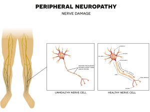 Top 6 Peripheral Neuropathy Question 2022 - What is Diabetic Neuropathy?