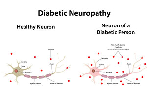 Neuropathy Relief Miami. Diabetic Neuropathy Causes, Symptoms, and Treatment. It is a common complication of diabetes that can cause a variety of symptoms, including numbness, tingling, and pain in the hands and feet.